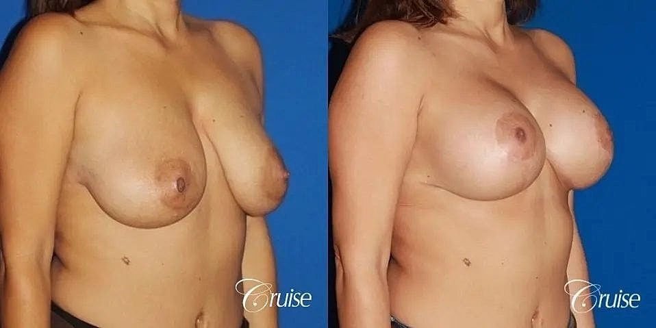 Breast Lift Augmentation Before & After