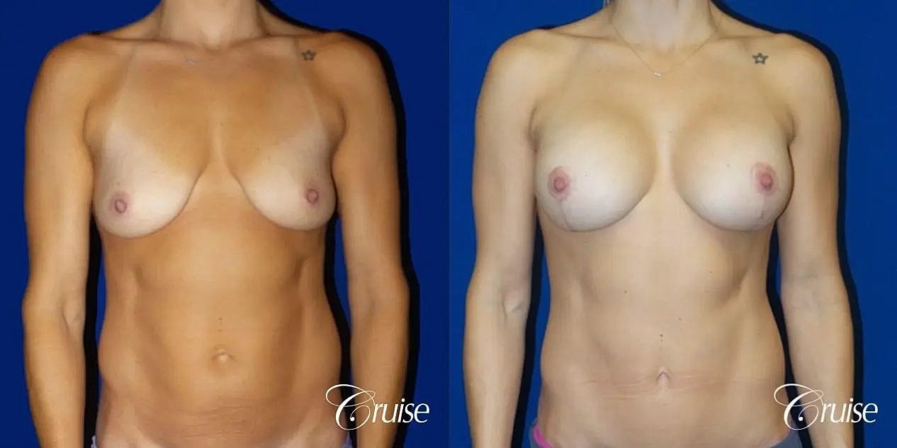 Breast Lift Augmentation Before & After