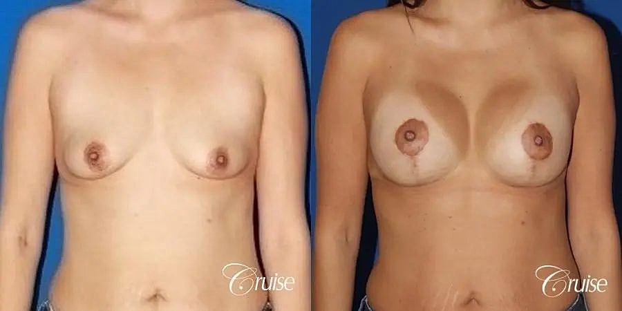 Breast Lift Augmentation Before & After
