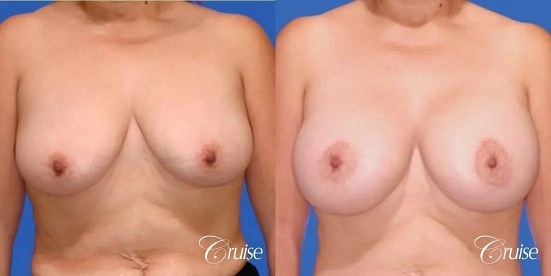 Breast Lift Augmentation Before & After