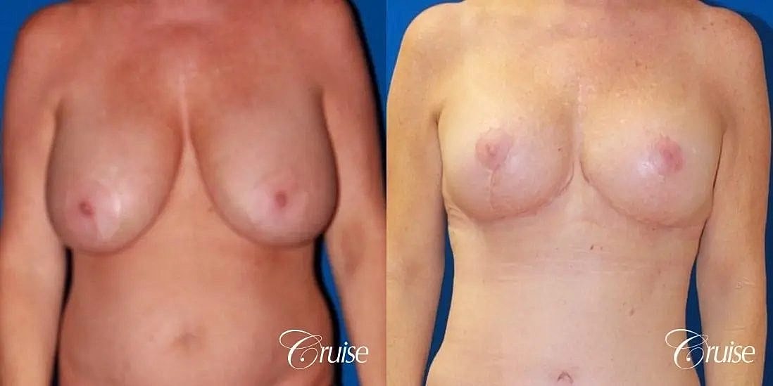 Breast Lift Augmentation Before & After