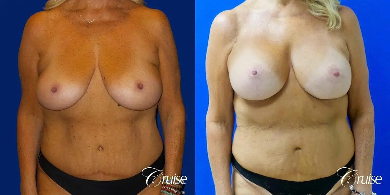 Breast Lift Augmentation Before & After