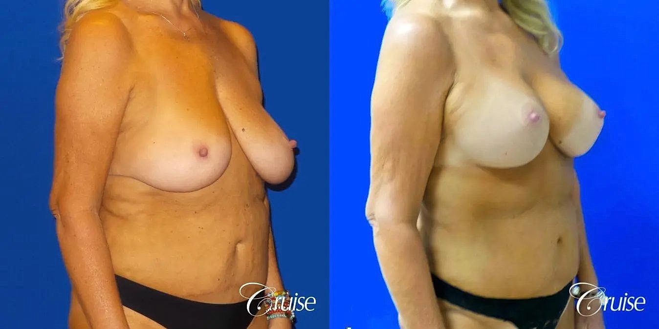 Breast Lift Augmentation Before & After