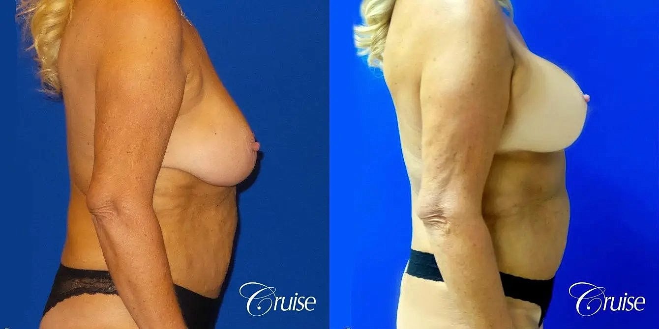 Breast Lift Augmentation Before & After