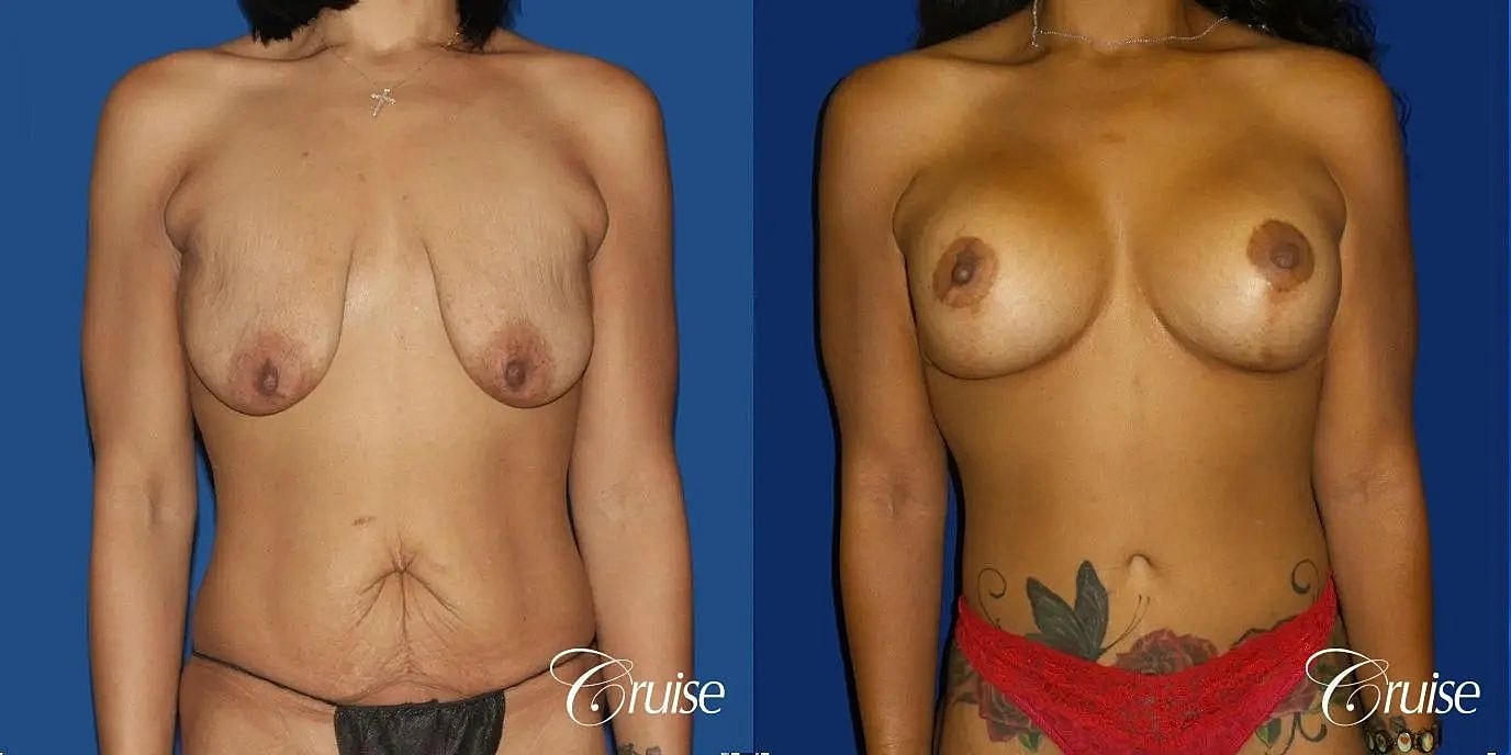 Breast Lift Augmentation Before & After