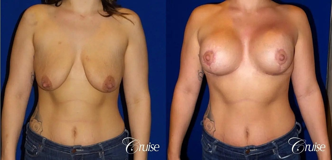Breast Lift Augmentation Before & After