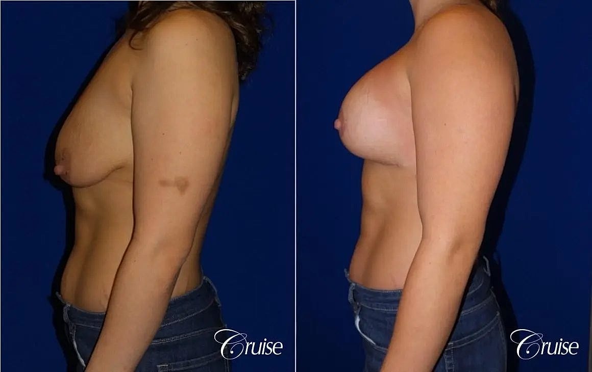 Breast Lift Augmentation Before & After