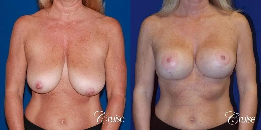 Breast Lift Augmentation Before & After