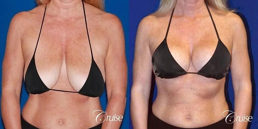 Breast Lift Augmentation Before & After