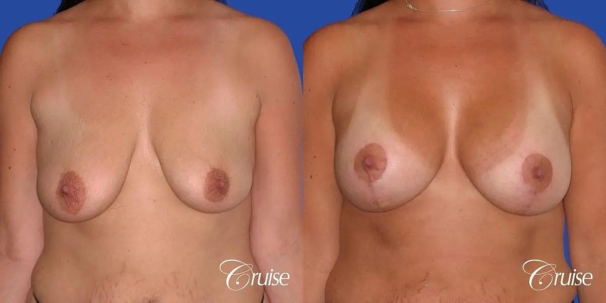 Breast Lift Augmentation Before & After