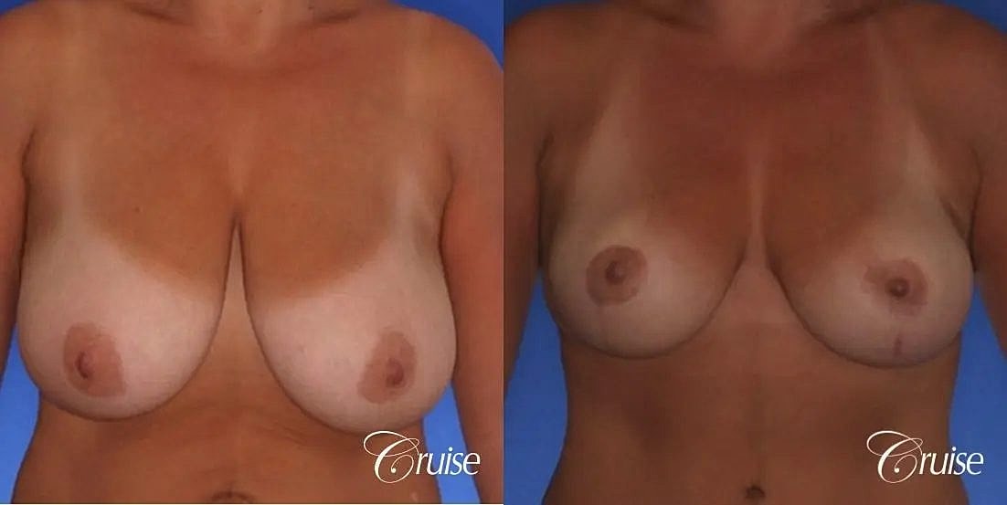 Breast Lift Augmentation Before & After