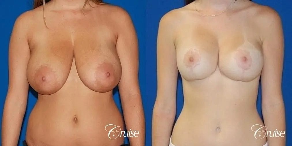 Breast Lift Augmentation Before & After