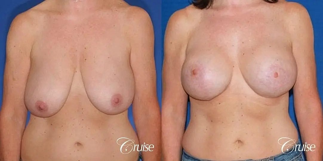 Breast Lift Augmentation Before & After