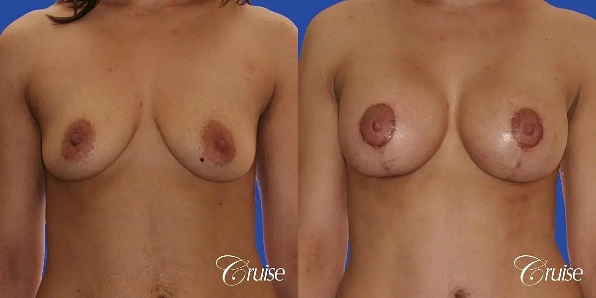 Breast Lift Augmentation Before & After