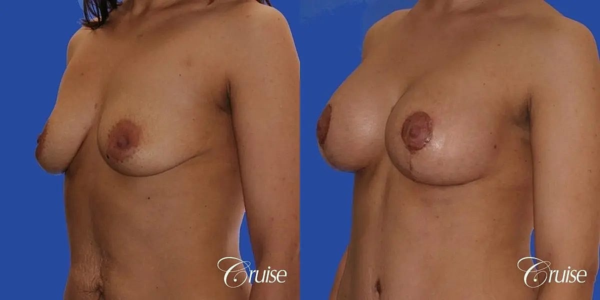 Breast Lift Augmentation Before & After