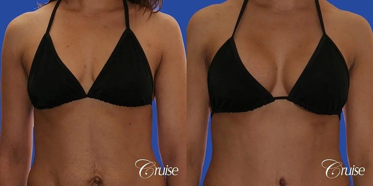 Breast Lift Augmentation Before & After