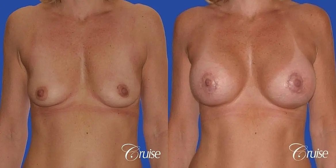 Breast Lift Augmentation Before & After