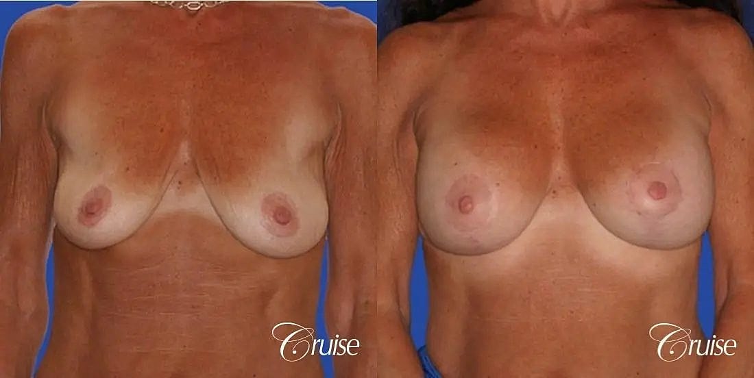 Breast Lift Augmentation Before & After