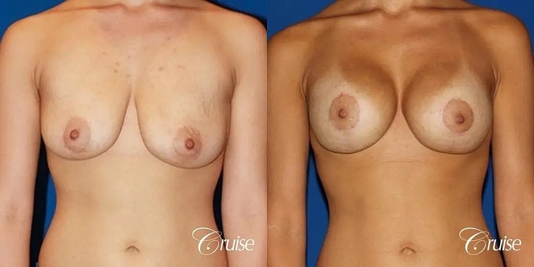 Breast Lift Augmentation Before & After