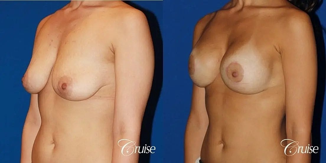 Breast Lift Augmentation Before & After