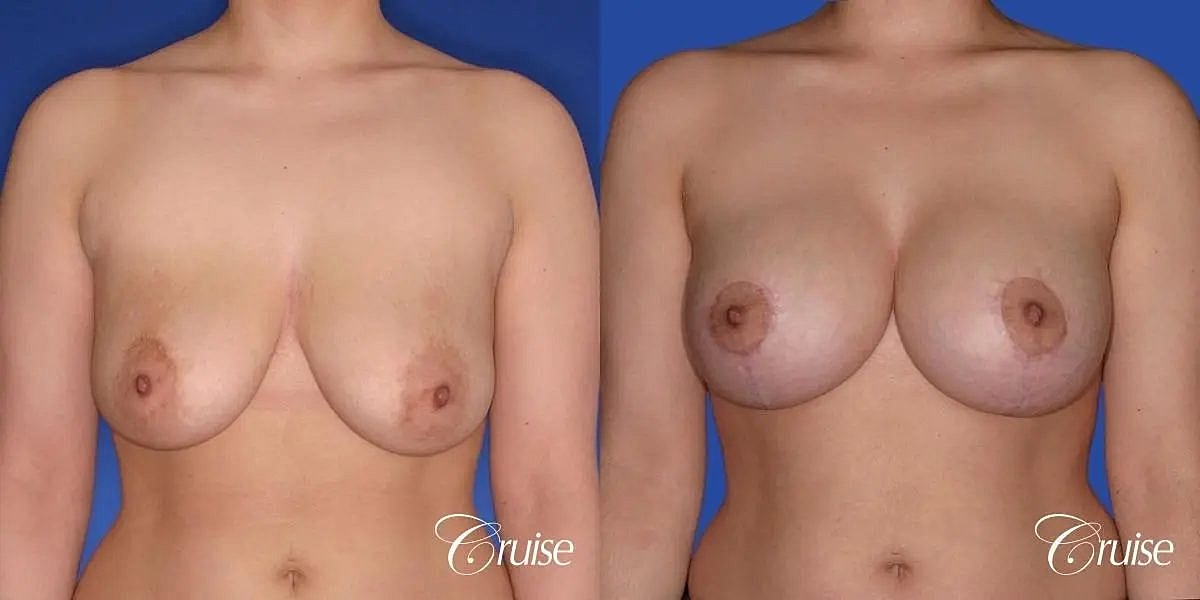 Breast Lift Augmentation Before & After