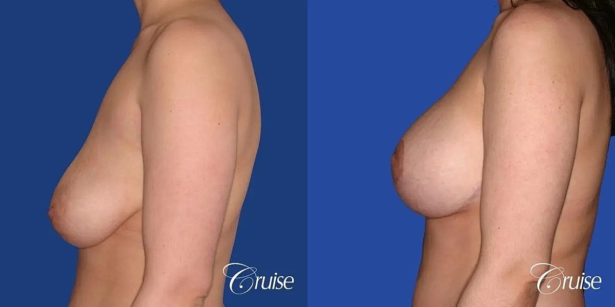 Breast Lift Augmentation Before & After