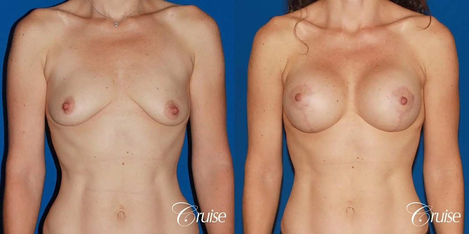 Breast Lift Augmentation Before & After