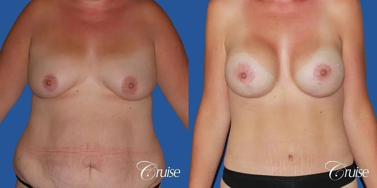 Breast Lift Augmentation Before & After