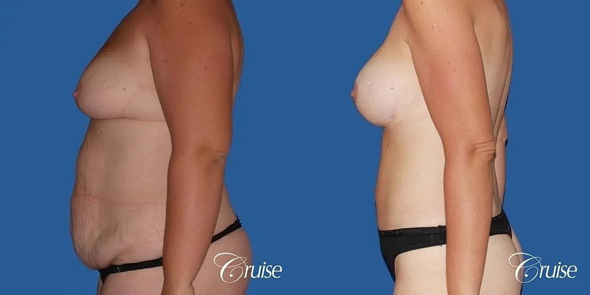Breast Lift Augmentation Before & After