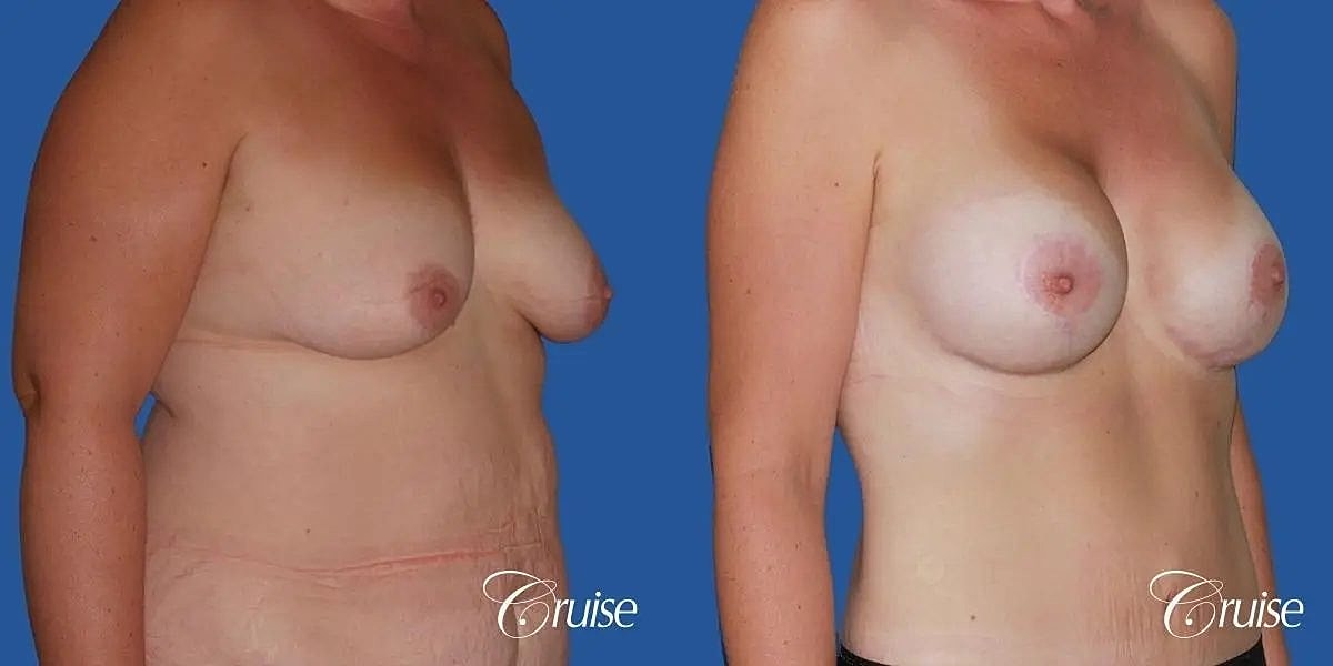 Breast Lift Augmentation Before & After