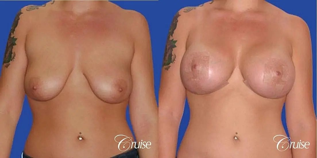 Breast Lift Augmentation Before & After