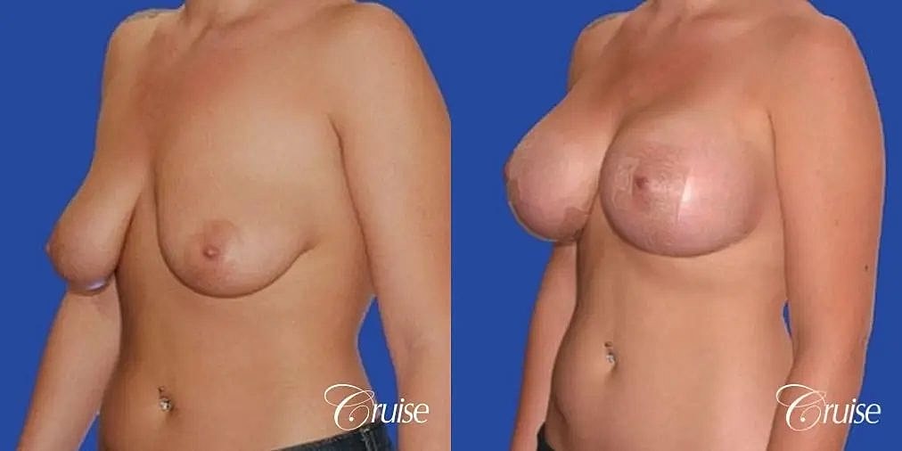 Breast Lift Augmentation Before & After