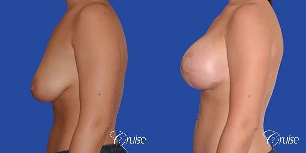 Breast Lift Augmentation Before & After