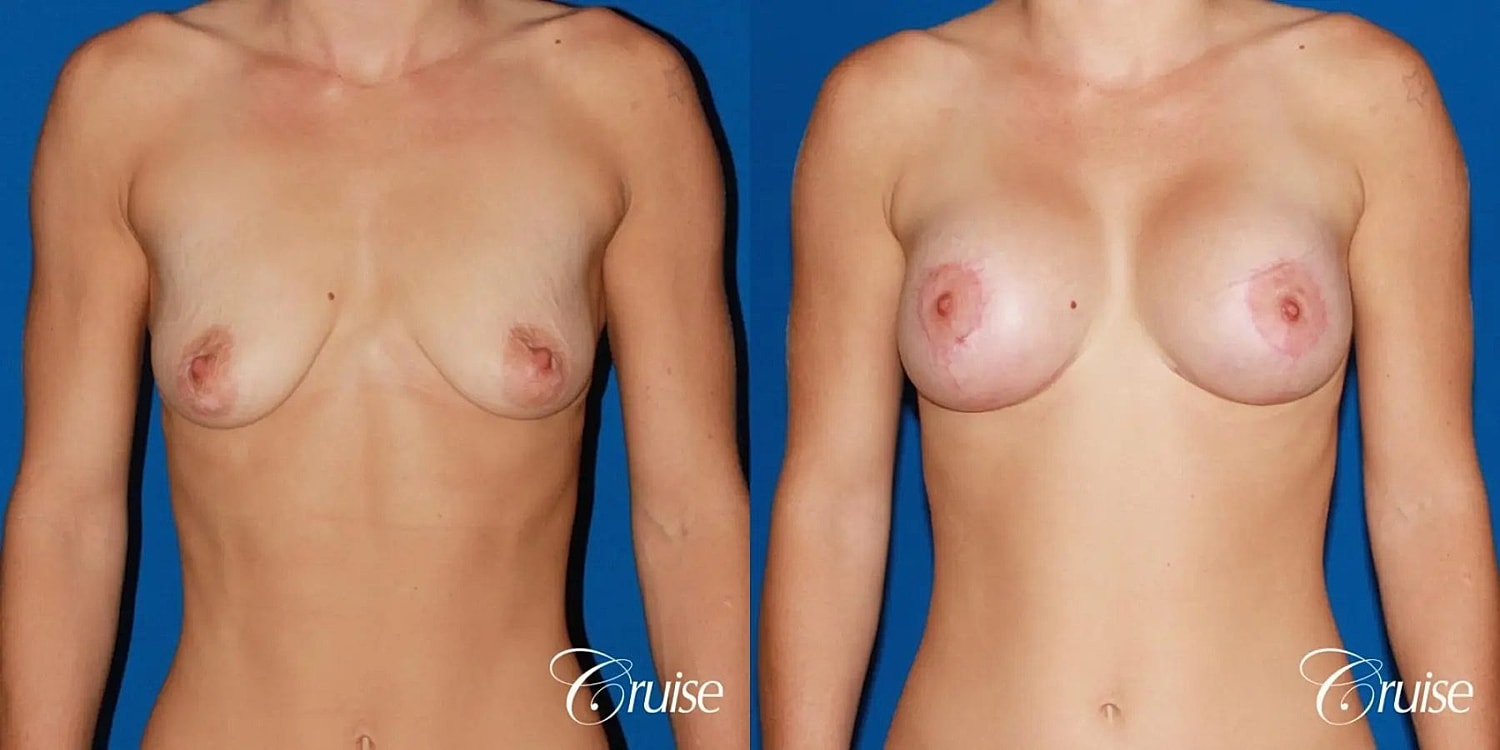 Breast Lift Augmentation Before & After