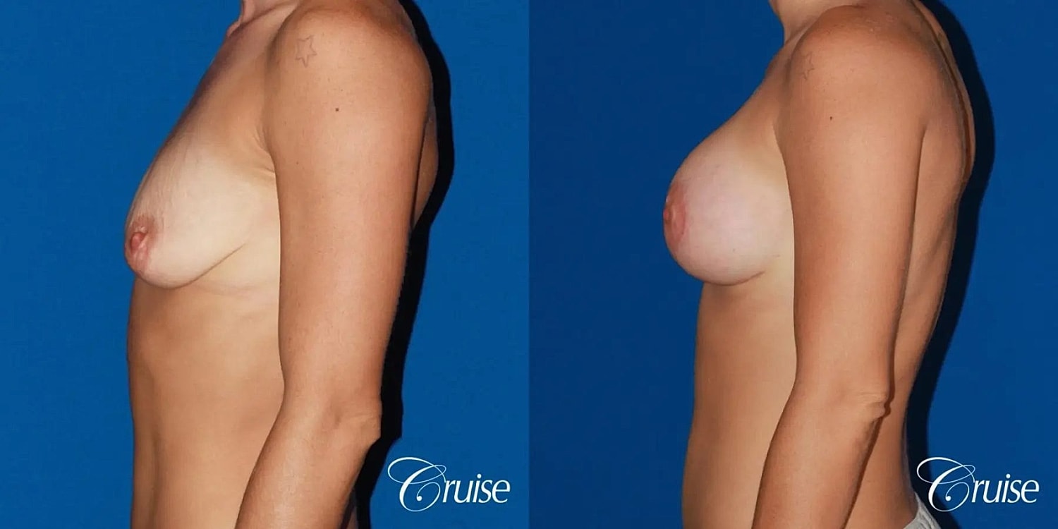 Breast Lift Augmentation Before & After