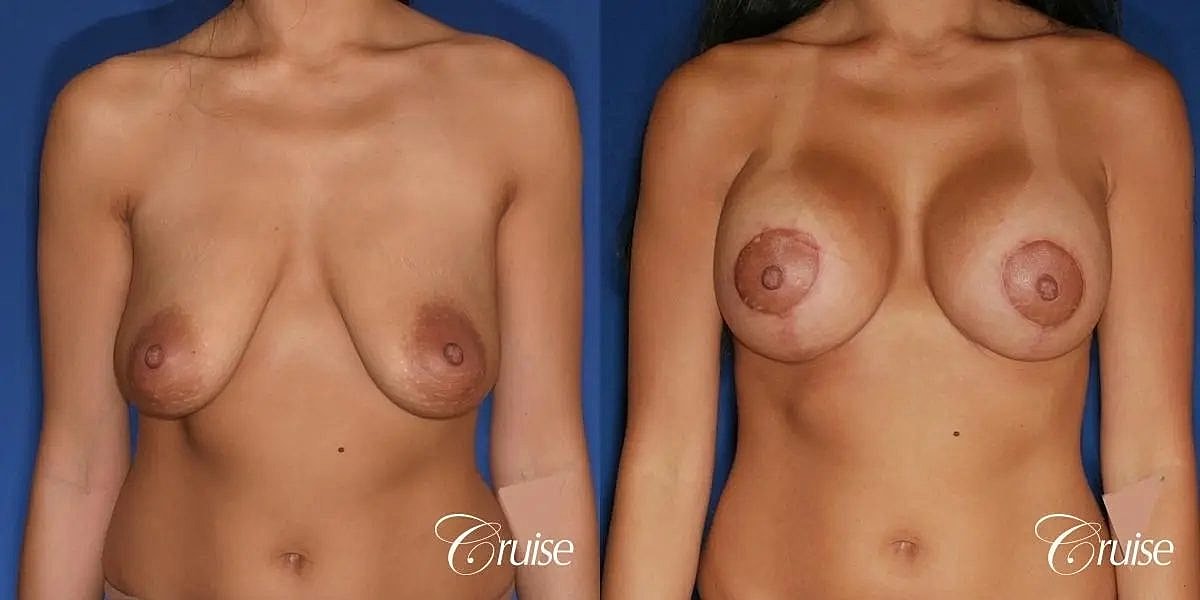 Breast Lift Augmentation Before & After