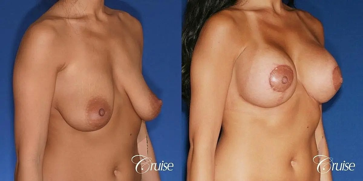 Breast Lift Augmentation Before & After