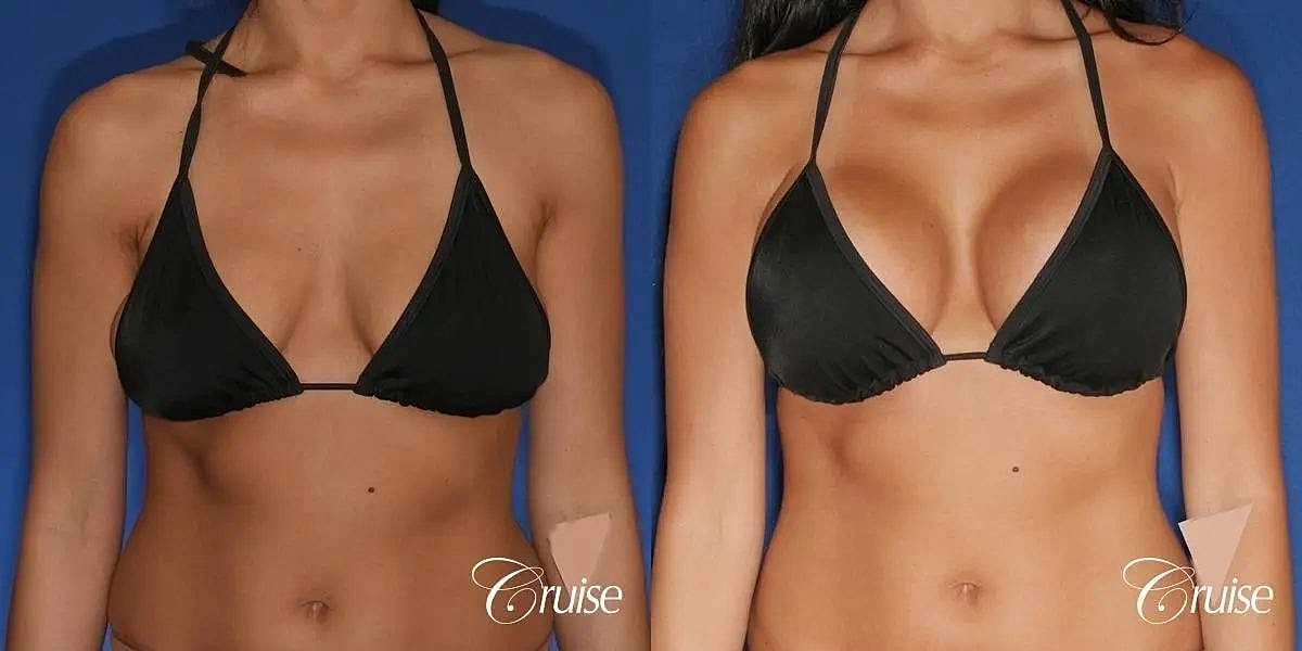 Breast Lift Augmentation Before & After