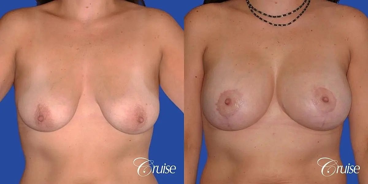 Breast Lift Augmentation Before & After