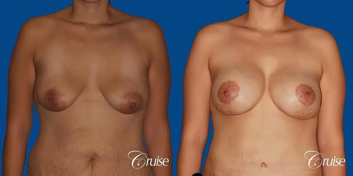 Breast Lift Augmentation Before & After