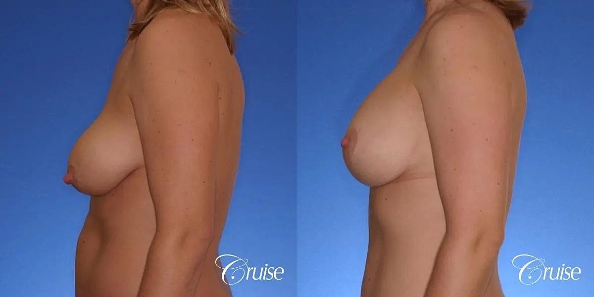 Breast Lift Augmentation Before & After