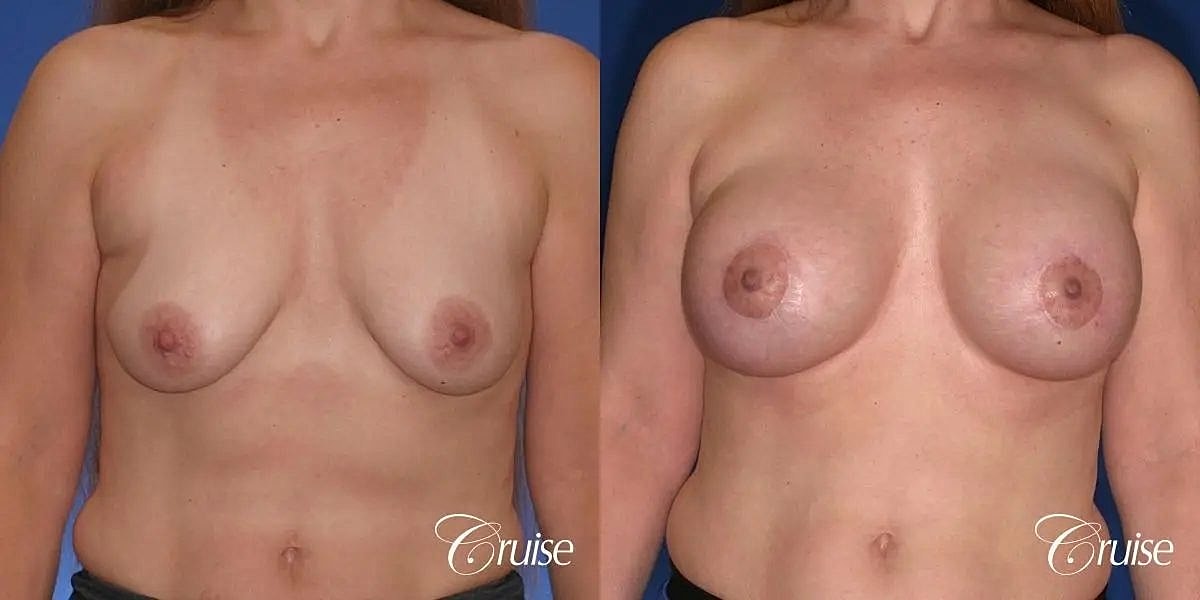 Breast Lift Augmentation Before & After