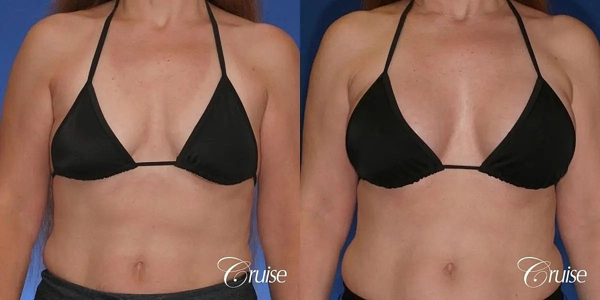 Breast Lift Augmentation Before & After