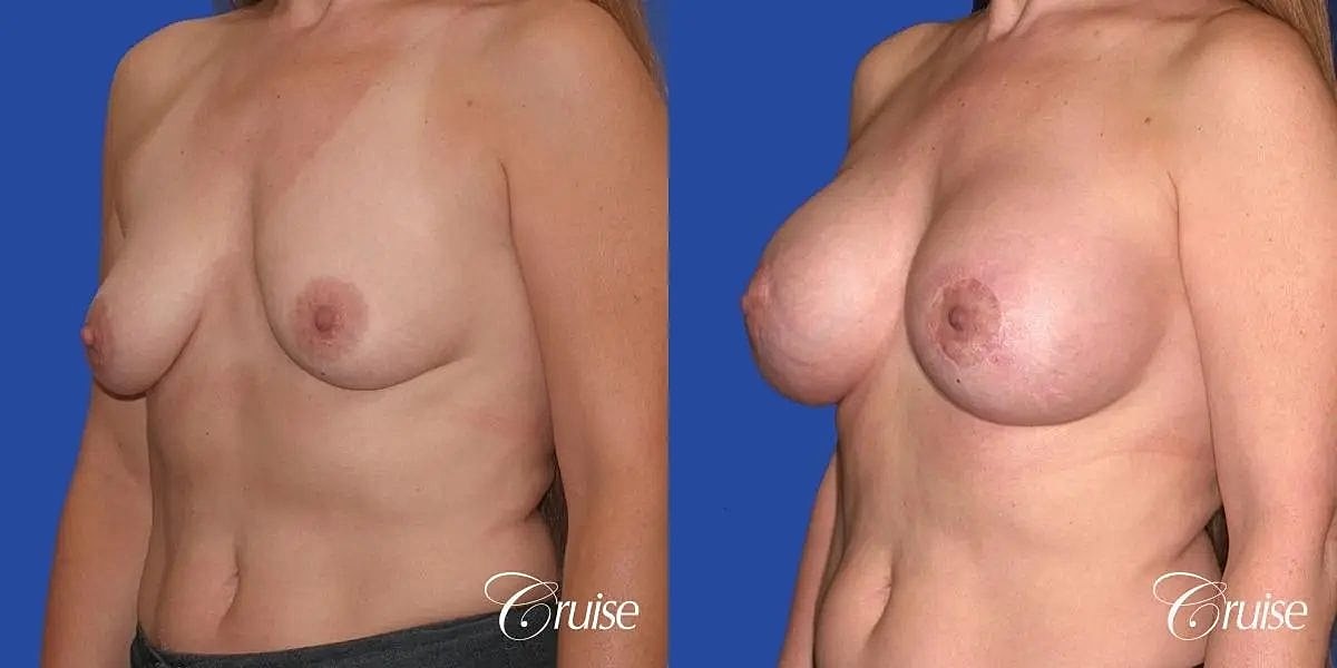 Breast Lift Augmentation Before & After
