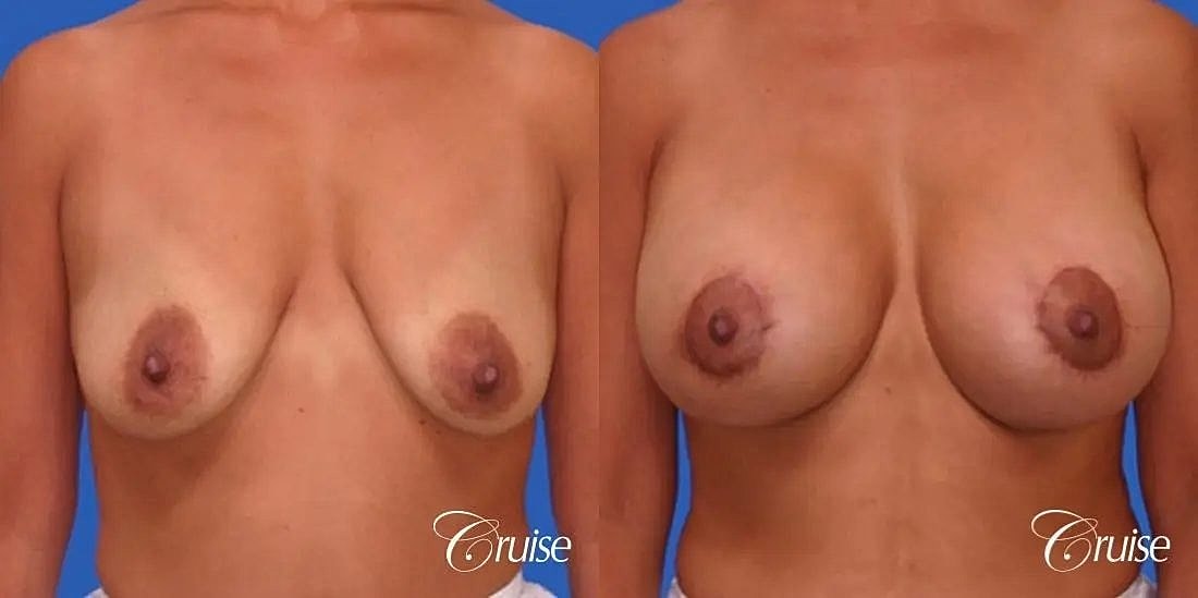 Breast Lift Augmentation Before & After