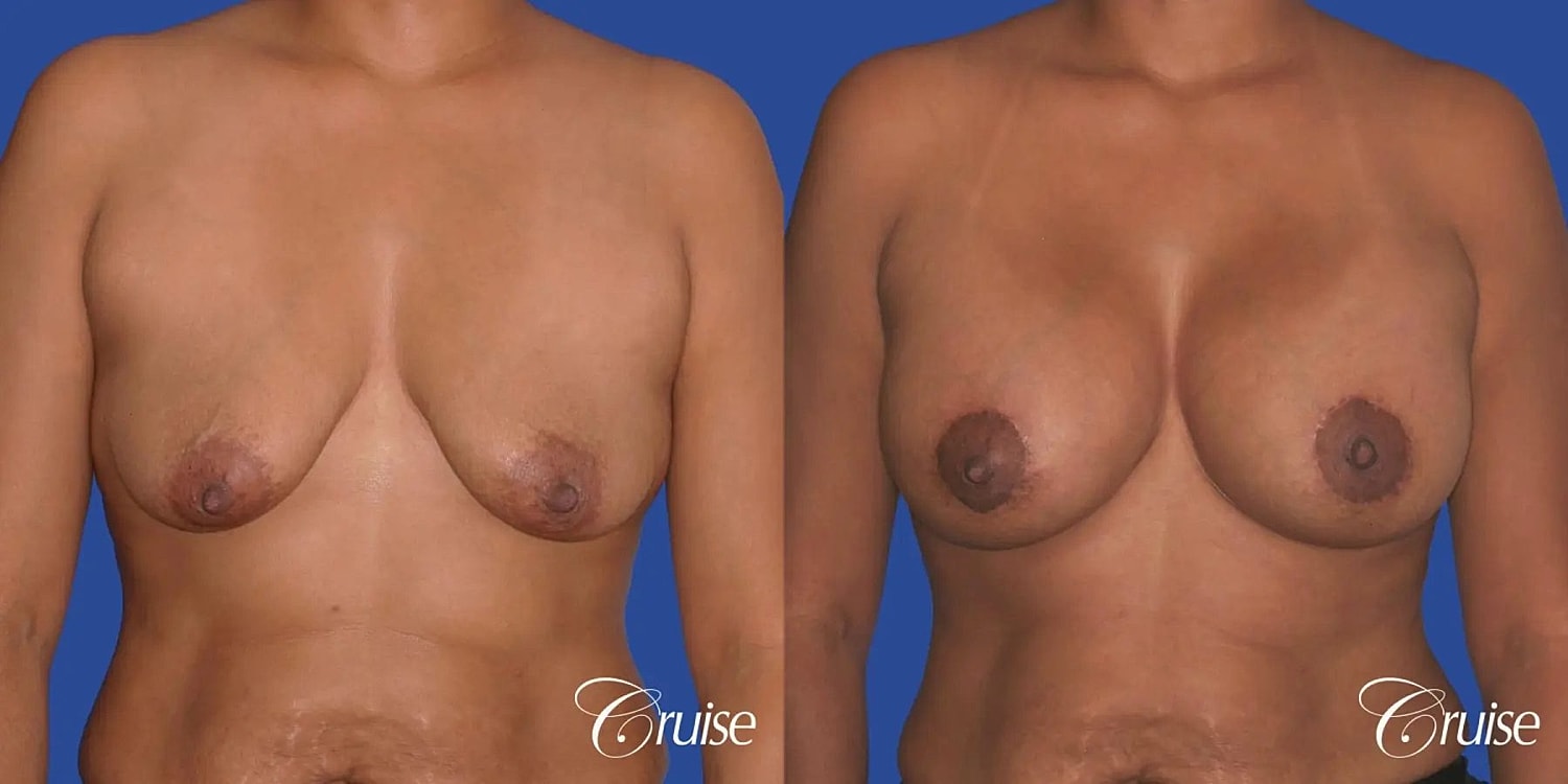 Breast Lift Augmentation Before & After