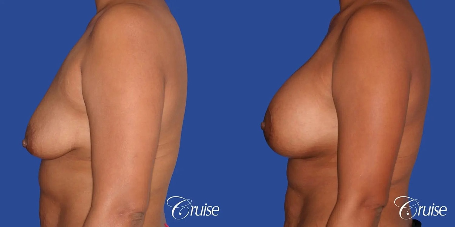 Breast Lift Augmentation Before & After