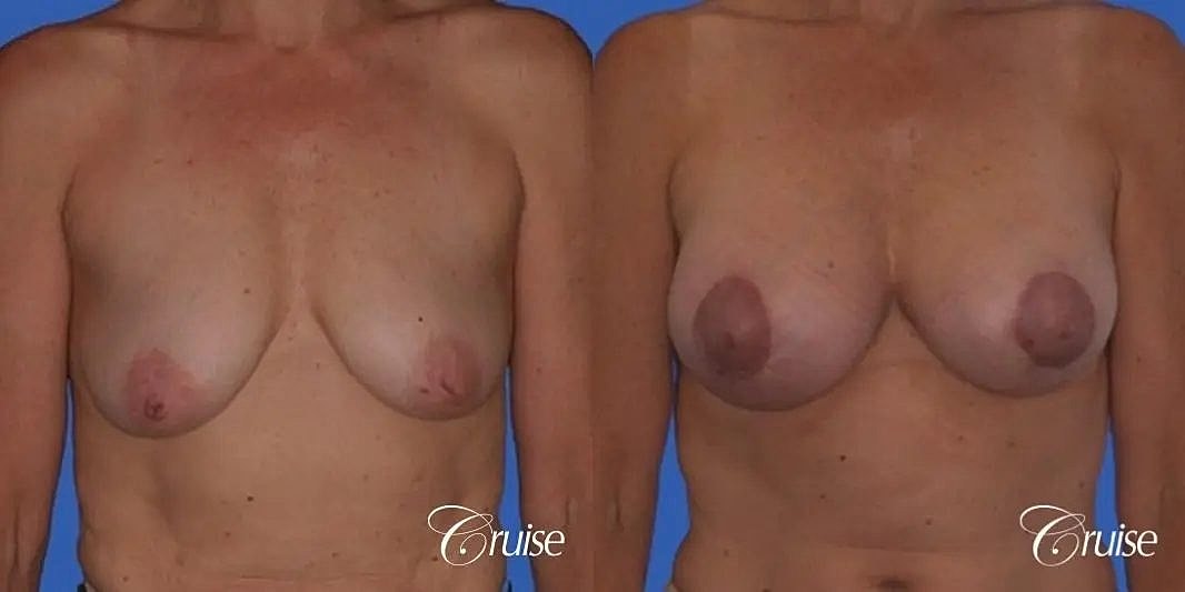 Breast Lift Augmentation Before & After