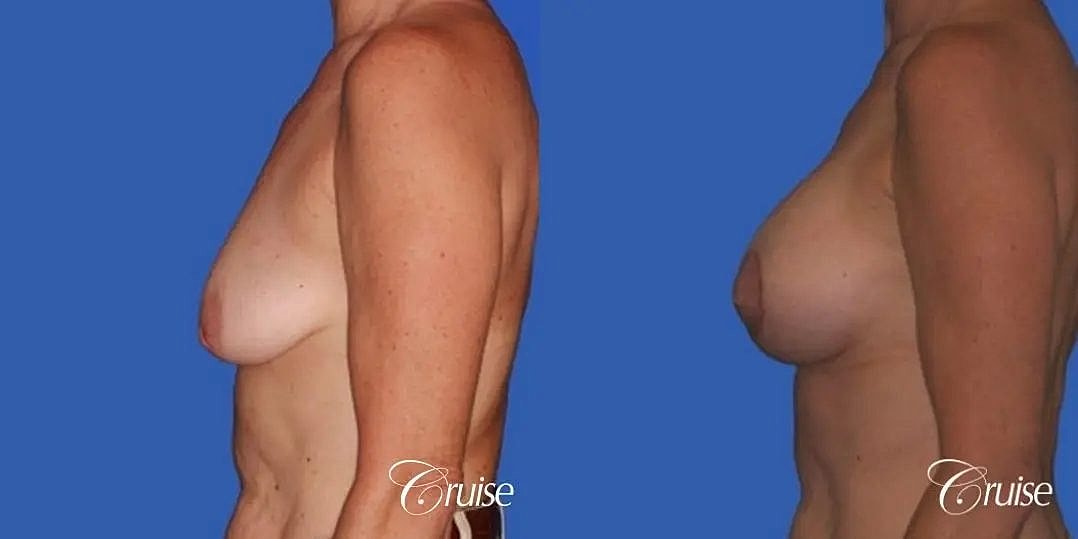Breast Lift Augmentation Before & After
