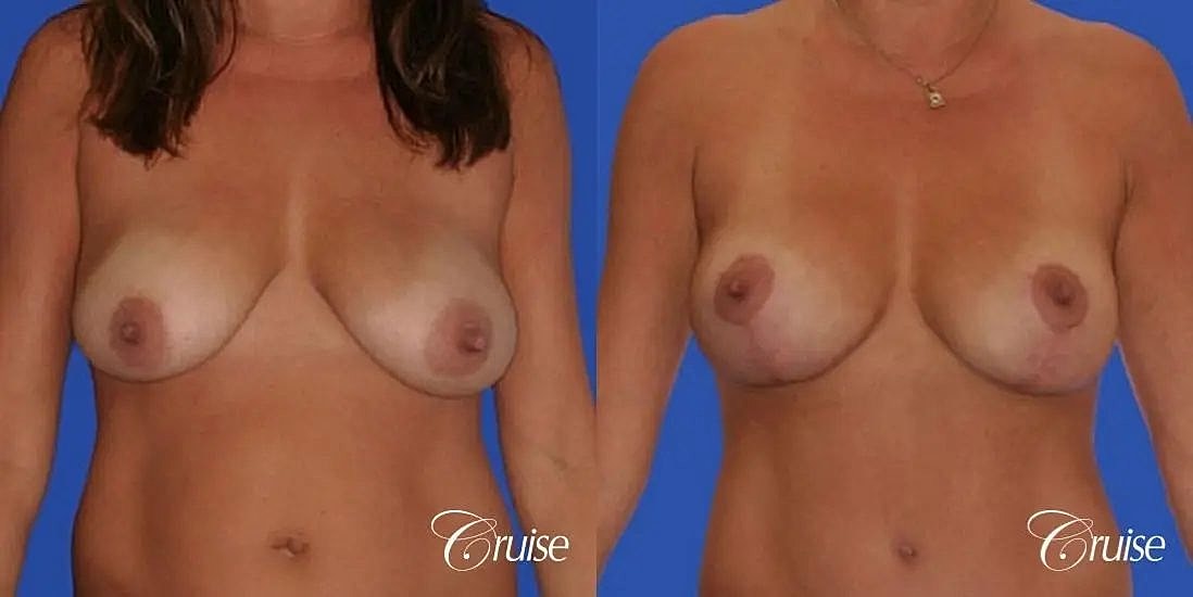 Breast Lift Augmentation Before & After